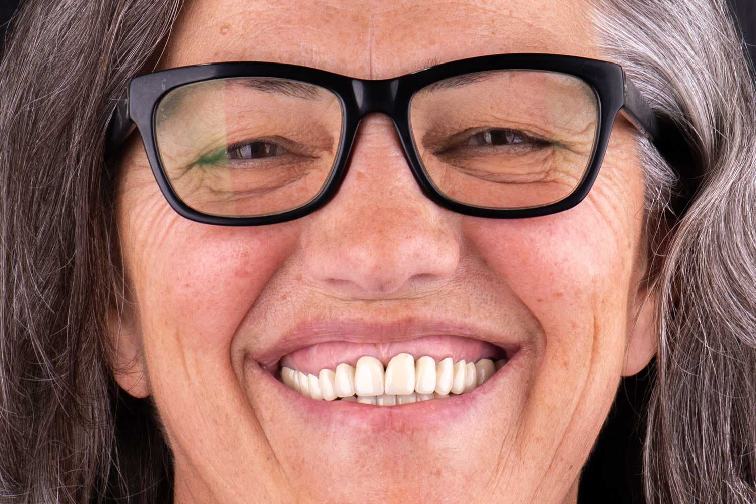 Kortikotomi estetike